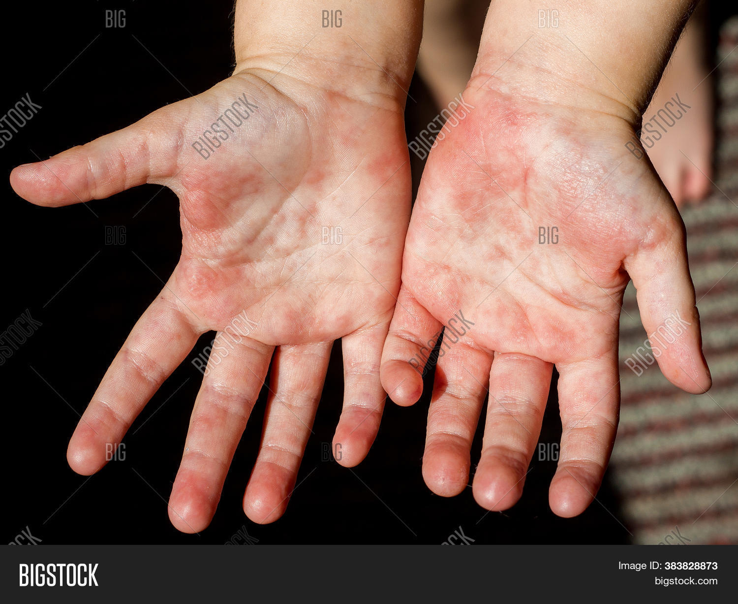 Red Hot Spots On Palms Of Hands Best Sale Dakora co