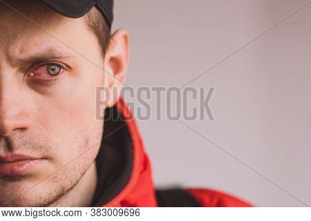 Broken Blood Vessel In Man\'s Eye. Man With The Subconjunctival Hemorrhage.