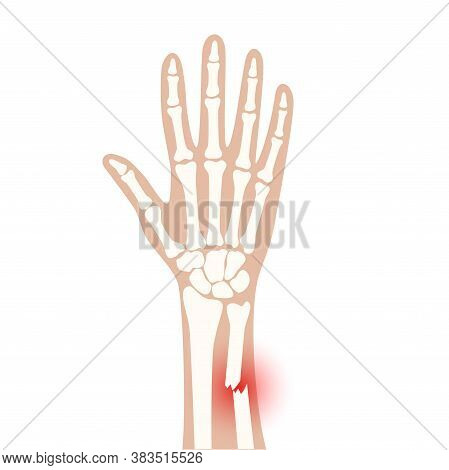 X Ray Of Arm Fracture With Red Pain Point And Inflammination. Broken Hand With Inner Closed Greensti