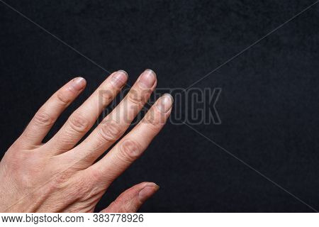 Close-up Of Female Caucasian Hand With Dirty Brittle Nails, Broken Nails On A Black Background. Nail