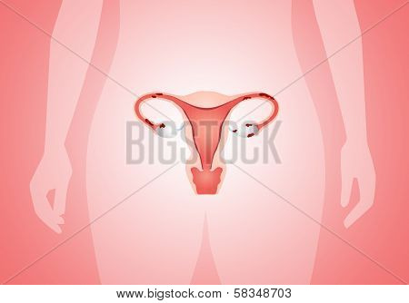 Endometriosis