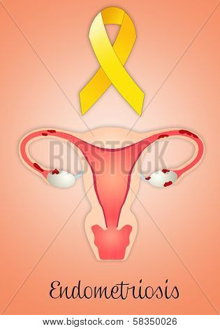 Endometriosis