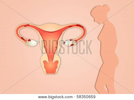 Endometriosis With Woman Silhouette On Pink Background