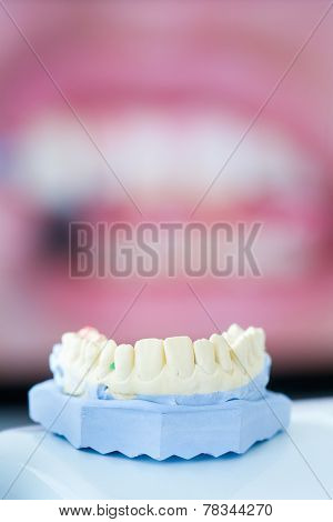 Dental Gypsum Mold