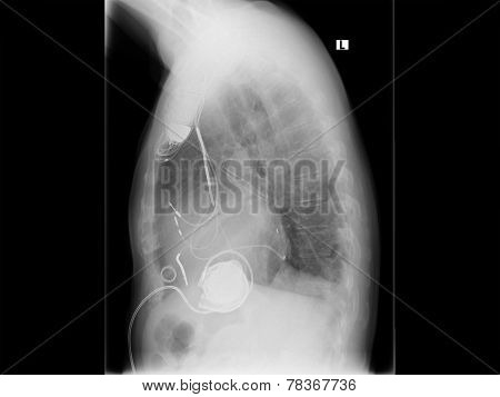 Radiograph, Chest, Heart Pacemaker