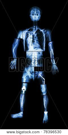 X-ray Whole Body And Multiple Fracture. He Was Operated And Internal Fixation By Plate & Screw