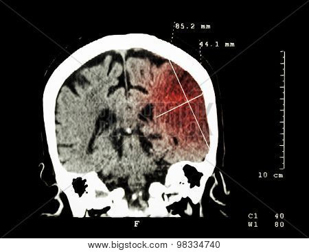 Cerebral Infarction At Left Hemisphere ( Ischemic Stroke ) ( Ct-scan Of Brain )