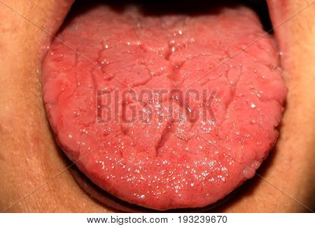 Candidiasis in the tongue. White coating. Thrush