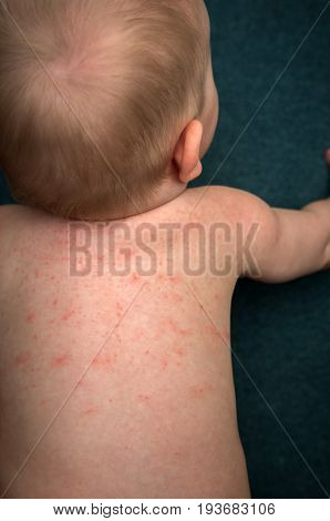 Allergies pimples on the baby's skin. Food allergy. Skin diseases symptoms.