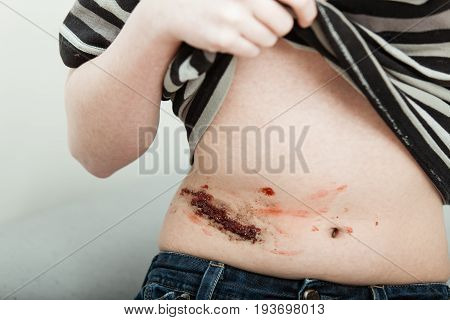 Young Boy With A Nasty Wound On His Abdomen