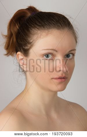 Herpes sore with pus on the lips of the young beautiful girl and a white cream on her finger