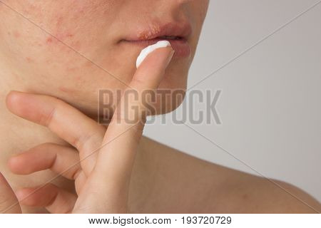 Herpes sore with pus on the lips of a young girl and pimples on the face a cream for healing on a finger
