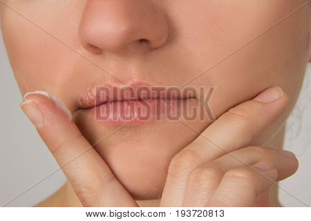 Herpes sore with pus on the lips of the young beautiful girl and a white cream on her finger