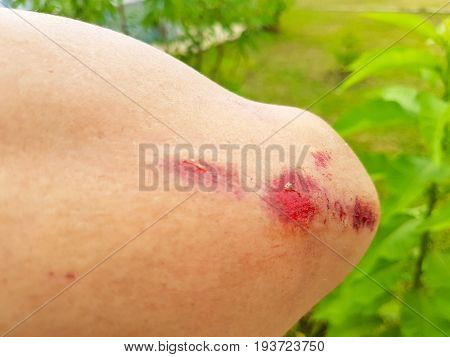 abrasions on the elbow with fresh wound