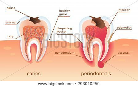 Unhealthy Teeth Stand In Raw In Gums. Tooth Decay Cross Section With All Parts. Caries Holes, Period