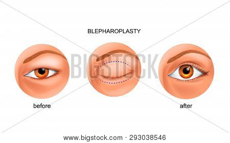 Vector Illustration Of Blepharoplasty Of The Asian Eyelid