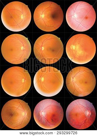 Collection Of Retinal Image  Of The Patient Taken With Retinal Photography Machine.