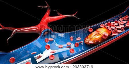 3dillustration Of Cerebral Sclerosis Isolated Black Background