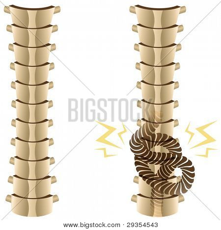 An image of a healthy spine and a knotted spine.