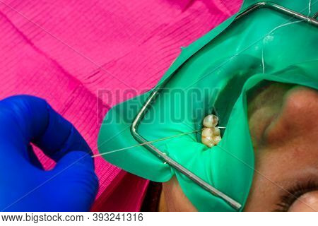 Installation Of A Cofferdam To The Patient, Modern Dental Equipment, Treatment In Sterile Conditions