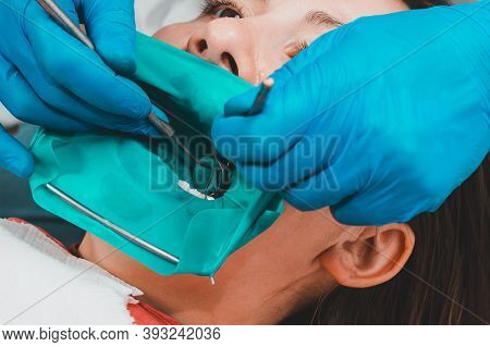 Restoration Of A Chewing Surface By Means Of Material For Filling With Photopolymer By Means Of The 