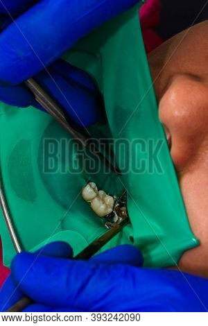 Restoration Of A Chewing Surface By Means Of Material For Filling With Photopolymer By Means Of The 