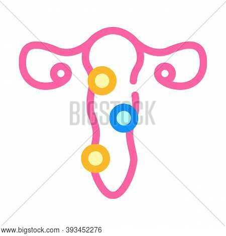 Pathology Of Cervix Color Icon Vector Illustration