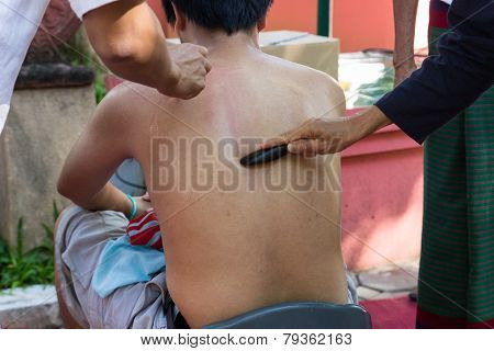The Teacher Demonstrate Guasa Technique Which Is The Alternative Medicine  For Skin Detoxifying On M