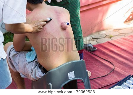 The Teacher Demonstrate Guasa And Skin Vacuum Technique Which Is The Alternative Medicine  For Skin