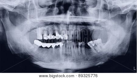 Panoramic x-ray of the mouth both the upper and lower jaws for oral surgeries and implantology.