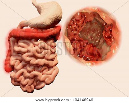Tumor in the intestine