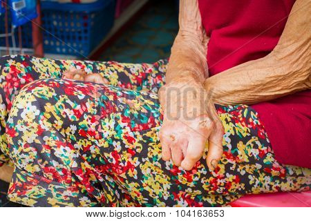 Closeup Hands Of Old Woman Suffering From Leprosy, Amputated Hands.