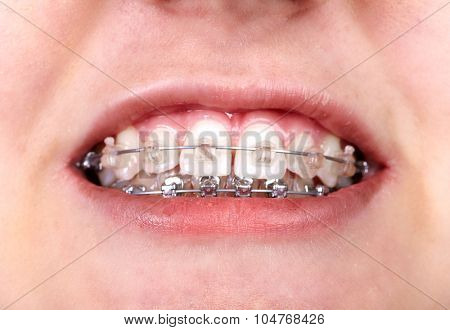 Teeth with orthodontic brackets. Dental health care.