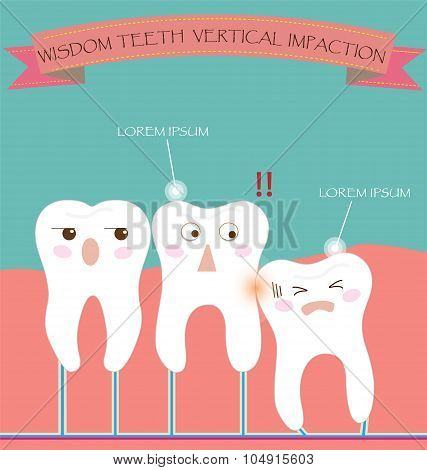 Wisdom Teeth Vertical Impaction