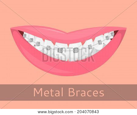 Dental braces, smiling lips in cartoon style isolated. Smile with braces, illustration on the topic of stomatology, orthodontics, teeth alignment bite correction, vector illustration for your projects