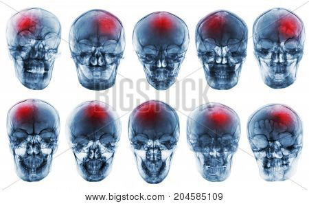 Stroke . Cerebrovascular Accident . Set Of Film X-ray Skull