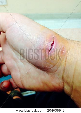 Dog Bite Fresh Wound Skin Waithing For Nurse And Doctor Treatment In Hospital. Big Hurt Fresh Punctu