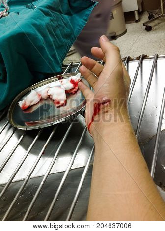 Fresh Red Blood From Wound From Mad Dog Canine Tooth Waithing For Treatment In Hospital. Big Fresh W