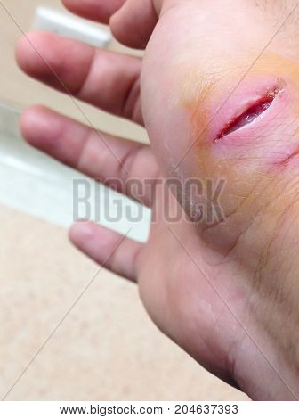 Dog Bite Fresh Wound Skin Waithing For Nurse And Doctor Treatment In Hospital. Big Hurt Fresh Punctu
