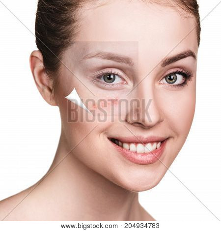 Layer with acne unstick from good healthy skin of young woman.