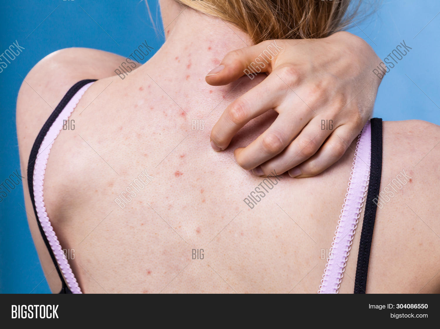Health Problem Skin Image Photo Free Trial Bigstock