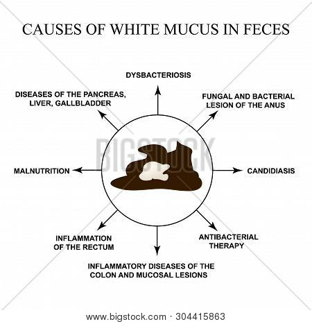 Causes Of White Mucus In Feces. Diseases Of The Gastrointestinal Tract. Infographics. Vector Illustr