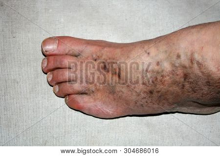 Leg. Varicose Veins. Phlebeurysm. Thrombophlebitis. Leg In Veins