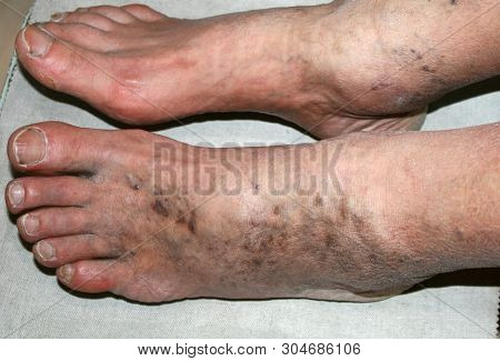 Leg. Varicose Veins. Phlebeurysm. Thrombophlebitis. Leg In Veins