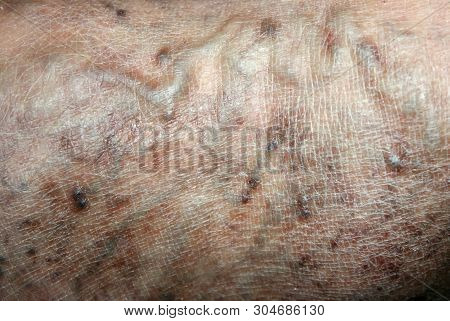 Varicose Veins. Phlebeurysm. Thrombophlebitis. Leg In Veins