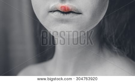Herpes On The Upper Lip Of A Young Woman. Medical Background Of A Young Beautiful Girl With Herpes L