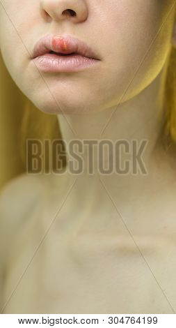 Herpes On The Upper Lip Of A Young Woman. Medical Background Of A Young Beautiful Girl With Herpes L