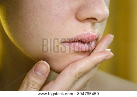 Woman Applying Ointment On Her Upper Lip With Herpes. Medical Background Of A Young Beautiful Woman 