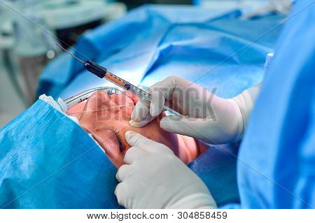 Lipofilling The Doctor Makes Fat Injections To The Patient In The Nasolabial Parts Of The Face.