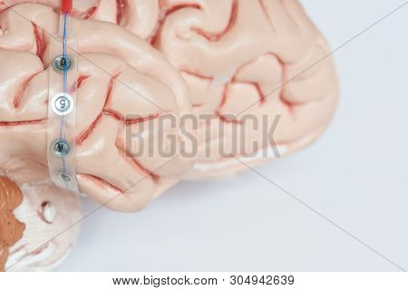 Subdural Grid Electrode For Brain Waves Recording Or Electroencephalography On The Side Of Artificia